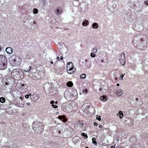 Several trophozoites of B. mandrillaris in brain tissue, stained with hematoxylin and eosin (H&E). 