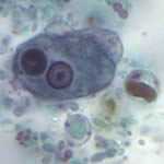Entamoeba histolytica, a protozoan parasite