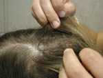 Es necesario examinar minuciosamente el cabello y el cuero cabelludo para detectar una infestación de piojos (Foto de los CDC)