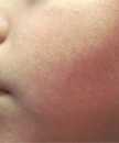 Left side of this boy’s face displaying signs of erythema infectiosum, or Fifth disease.