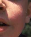 A boy showing symptoms of erythema infectiosum, otherwise known as Fifth disease.
