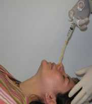 Image showing the proper technique for obtaining a nasopharyngeal specimen for isolation of Bordetella pertussis.