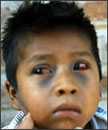 Niño con vasos sanguíneos rotos en los ojos y moretones en la cara a causa de accesos de tos por la tos ferina.