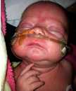 Bebé recibiendo tratamiento por infección grave de tosferina. 