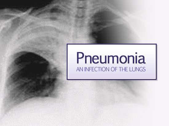 Chest x-ray of an adult patient with pneumonia.
