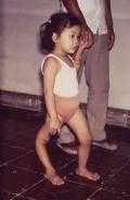 This child is displaying a deformity of her right lower extremity due to polio caused by the poliovirus, an enterovirus member.