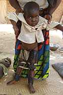 Young girl with leg braces following poliomyelitis, Chad