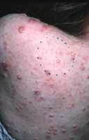 Severe case of molluscum on an immunocompromised patient's back. Image courtesy Inger Damon, MD, CDC.