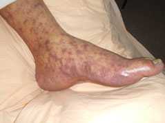 Rocky Mountain Spotted Fever rash on foot