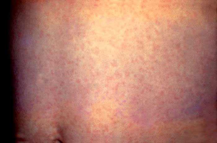 This person has a generalized rash on the stomach caused by rubella.