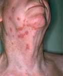 Shingles rash on face and neck.