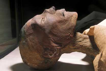 Traces of smallpox pustules found on the head of a 3000 year-old mummy of the Pharaoh Ramses V. Photo courtesy of World Health Organization (WHO)
