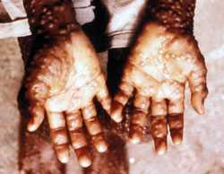 image of smallpox on hands