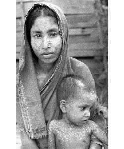 This mother and child have scars after surviving smallpox. The scars match the distribution pattern of smallpox. Source: CDC/Stanley O. Foster.