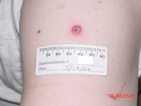 Example of a “take” on day 8 after vaccination in a revaccinee.