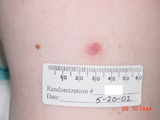Example of vaccine “take” on day 15 after vaccination in a revaccinee.