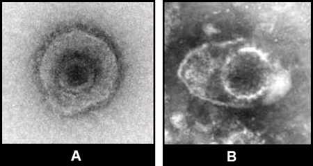 Figure 7: Two images (7-A and 7-B) of herpesvirus from clinical specimens. Herpesvirus from clinical specimens.