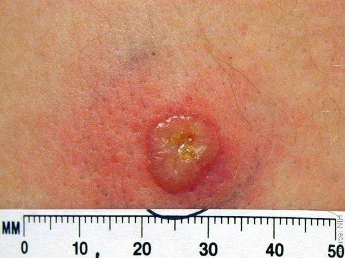 Normal primary, 8 days post vaccination. Large vesicle on erythematous base. Source: NIH, digital enhancement © Logical Images.