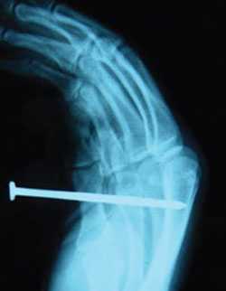 Radiografía de una lesión causada por pistola de clavos