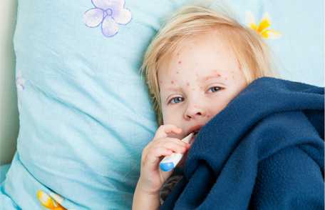 Un niño con varicela
