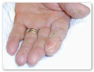 Vista de mano hacia arriba con los dedos mostrando dermatitis de contacto alérgico
