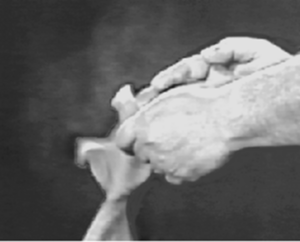 figura 1. Polvo producido al quitarse un guante de látex que contiene talco.