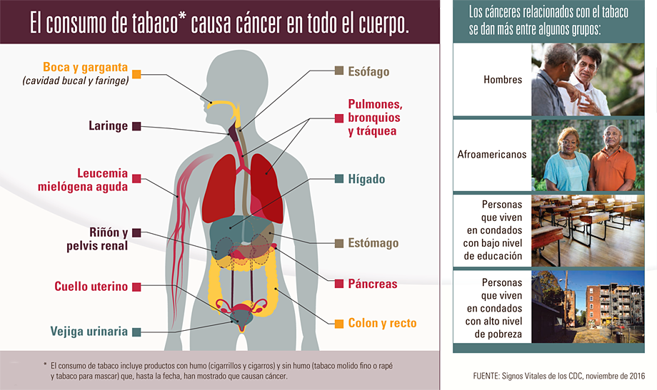 Infografía: El consumo de tabaco* causa cáncer en todo el cuerpo.