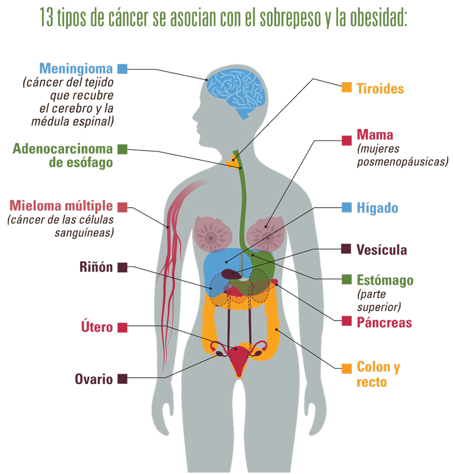 Infografía: 13 tipos de cáncer se asocian con el sobrepeso y la obesidad.