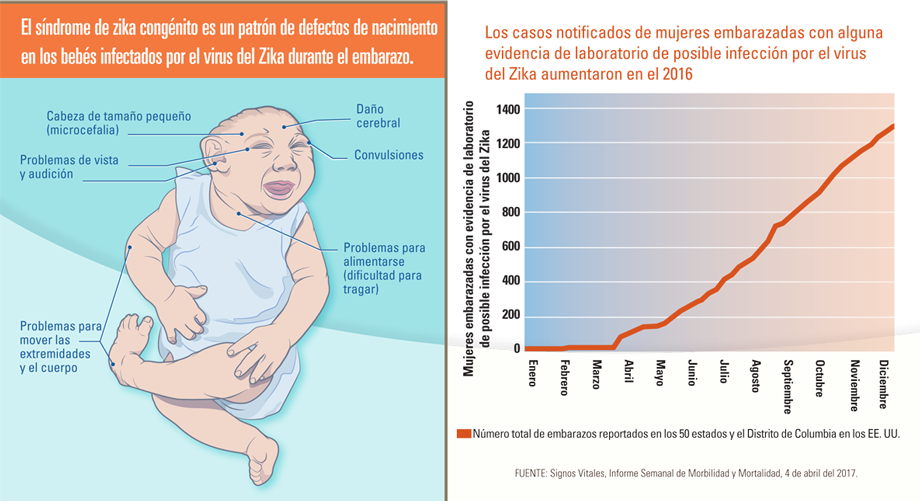 Infografía: El síndrome de zika congénito es un patrón de defectos de nacimiento en los bebés infectados por el virus del Zika durante el embarazo.