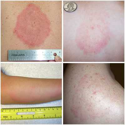 The many forms of Southern Tick Associated Rash Illness