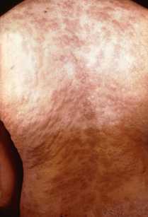 Сифилитическая сыпь на теле на вторичном периоде