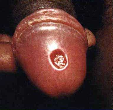 Primary stage syphilis sore (chancre) on glans (head) of the penis.