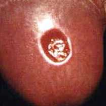 Ejemplo de una úlcera de sífilis primaria.