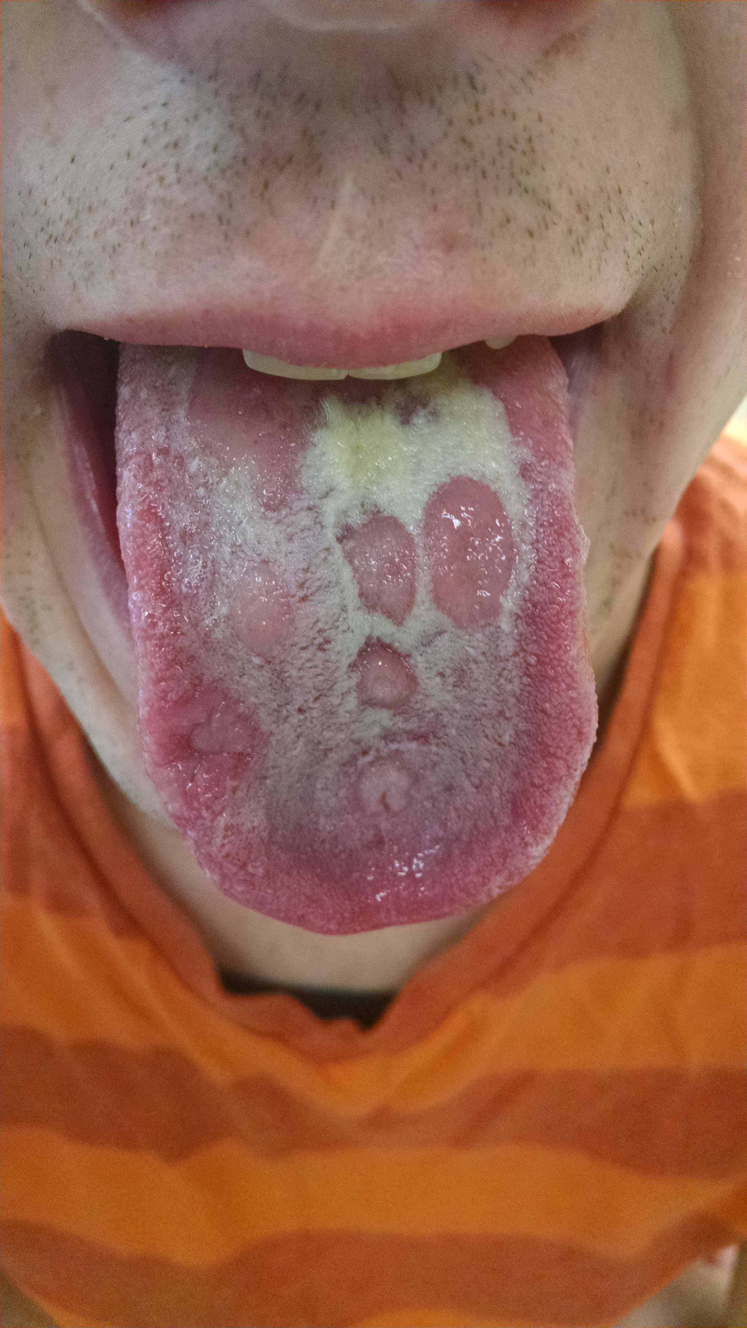 Image of Lesions of secondary syphilis on tongue