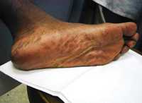 Secondary stage syphilis sores (lesions) on the bottoms of the feet. Referred to as "plantar lesions."