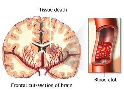 	Illustration of tissue death in the frontal cut-section of the brain, as well as a blood clot that caused the damage.