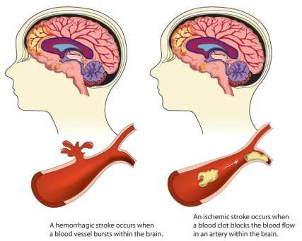 An illustration showing how a blood vessel can burst within the brain causing a hemorrhagic stroke, and how a blood clot within an artery of the brain can cause an ischemic stroke.