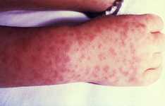 hand and forarm of patient with Rocky Mountain spotted fever with a red, spotted rash