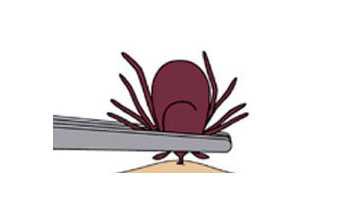 Clipart image showing how to remove an embedded tick with a pair of tweezers.