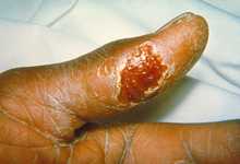 Ulcer on the thumb of a patient with tularemia