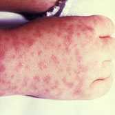 Photo of a persons hand with Rocky Mountain Spotted Fever rash