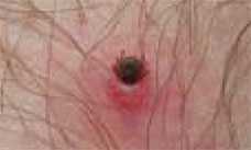 tick embedded into persons skin