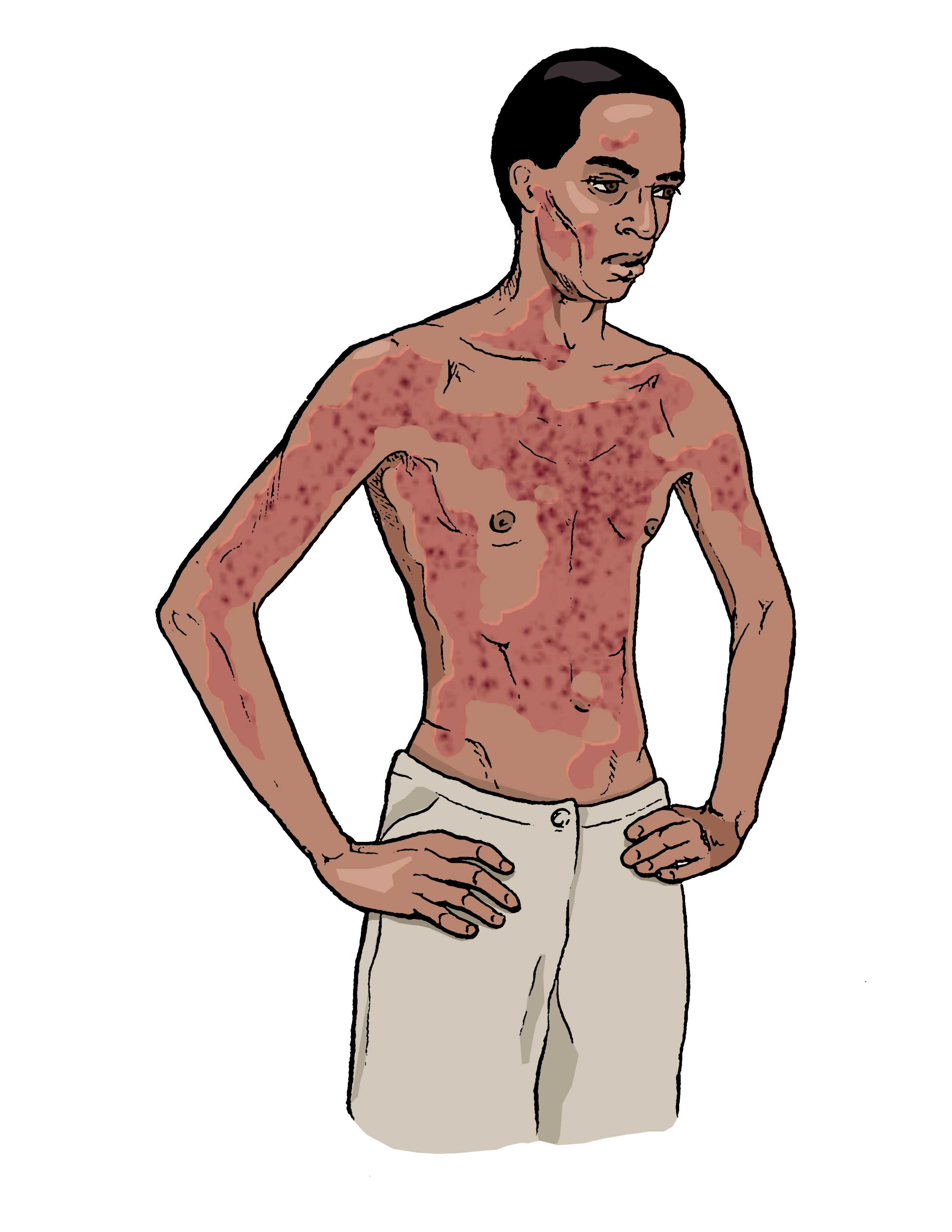 Ebola symptom: Skin rash