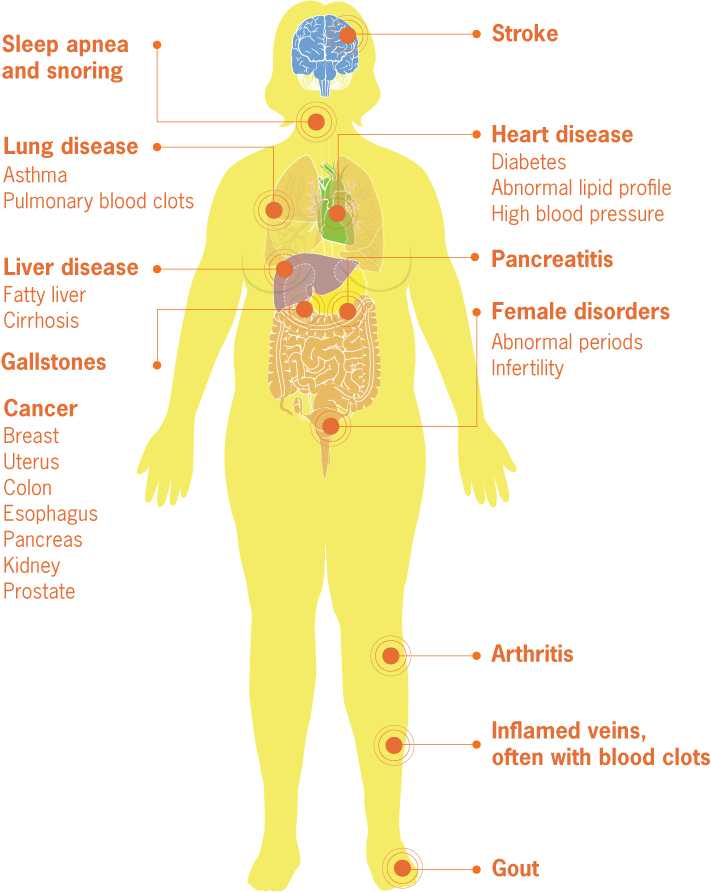 Graphic: Medical Complications of Obesity - Obesity affects many body parts:  brain (stroke); throat (sleep apena, snoring); lungs (lung disease, asthma, pulmonary blood clots); heart (heart disease, diabetes, abnormal lipid profile, high blood pressure); liver (liver disease, fatty liver, cirrhosis); pancreas (pancreatitis); gall bladder (gallstones); uterus (female disorders, abnormal periods, infertility); knees (arthritis); calves (inflamed veins, often with blood clots); feet (gout); breast, uterus, colon, esophagus, pancreas, kidney, prostate (cancer).