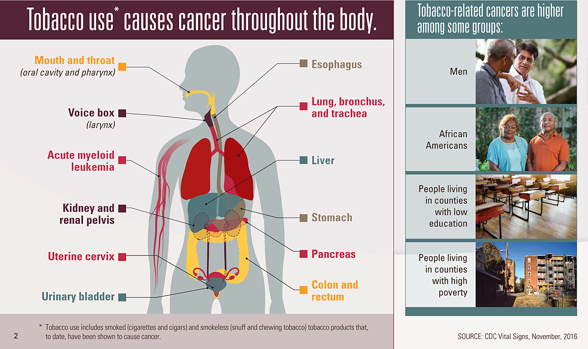 Graphic: Tobacco use* causes cancer throughout the body