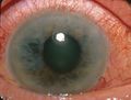Acute Angle Closure-glaucoma.jpg