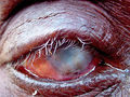 Corneal scarring trachoma.jpg