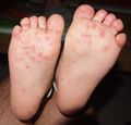 Hand foot and mouth disease on child feet.jpg