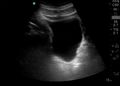 Normal sagittal bladder.jpg