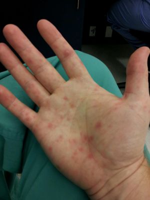 Hand lesions coxsackie virus.